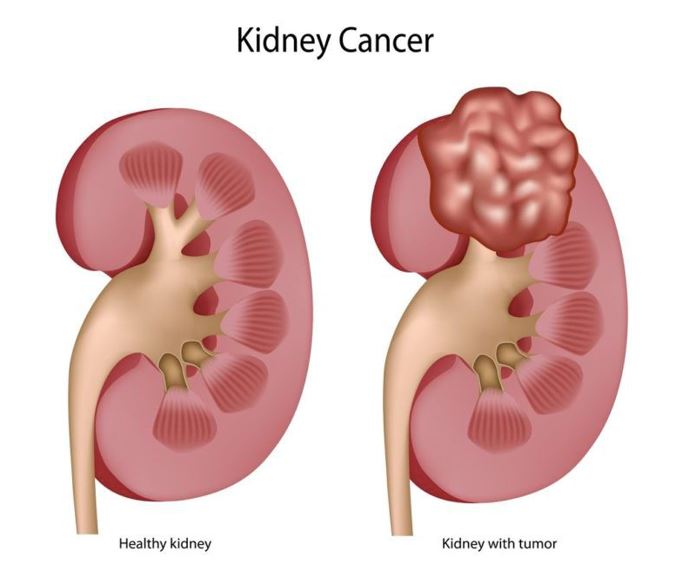 Kidney Cancer