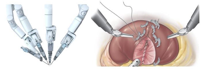 Kidney Cancer