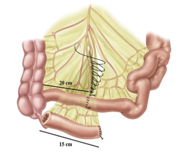 Urinary Bladder Cancer