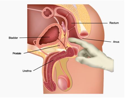 Prostate Cancer