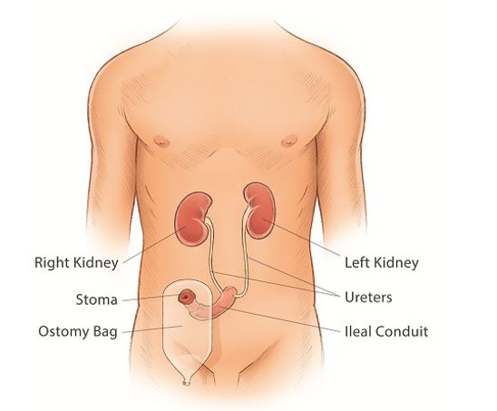 Urinary Bladder Cancer