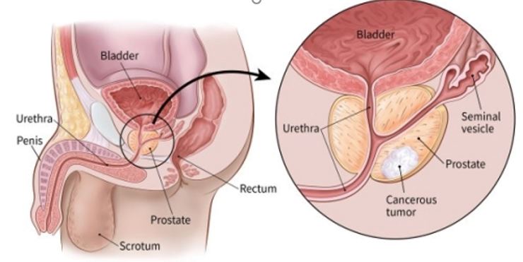 Prostate Cancer