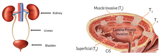 Urinary Bladder Cancer